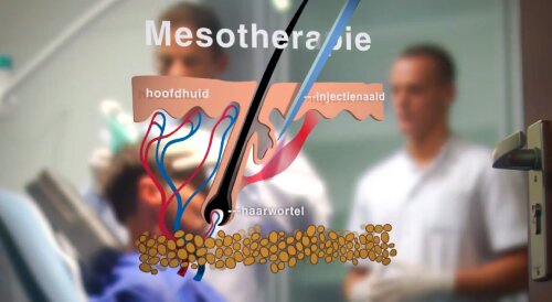 mesotherapie als behandeling haarverlies