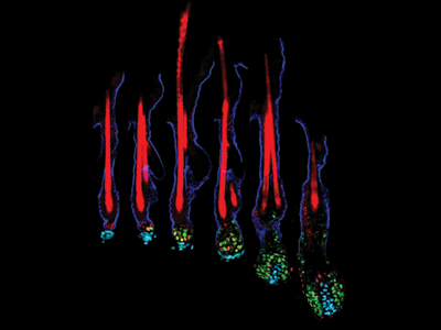 haarwortelonderzoek, trichogram, haaruitval, haarverlies