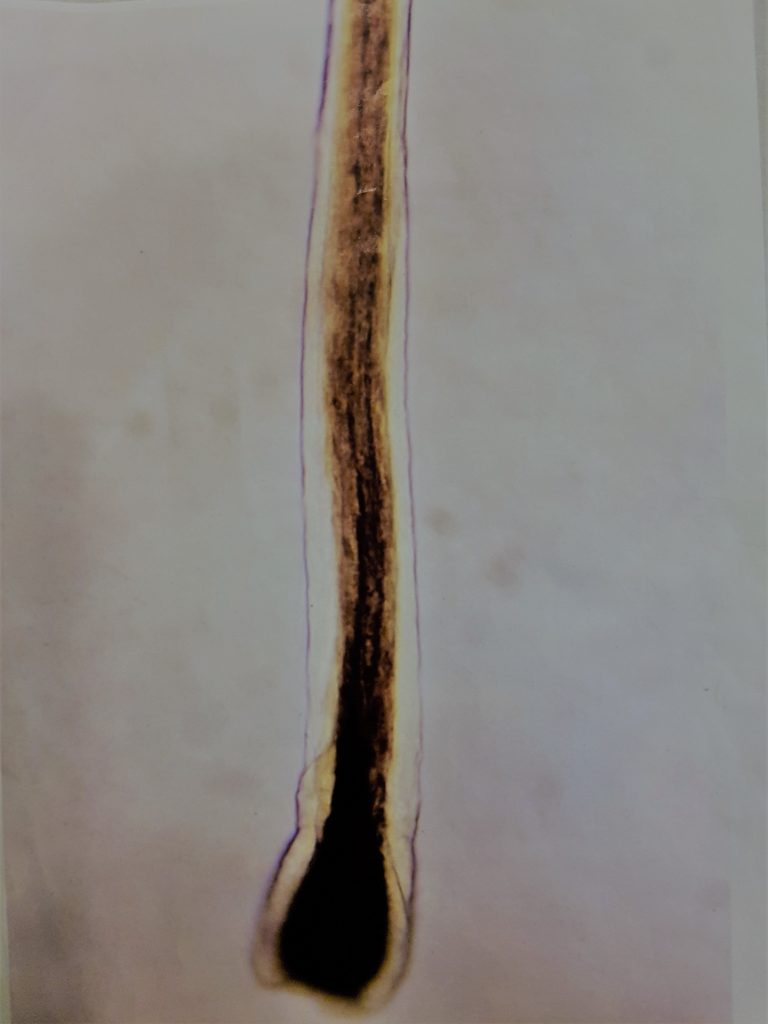 diffuus haarverlies bij vrouwen