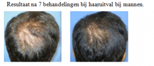 nieuwe behandeling dermapen 4